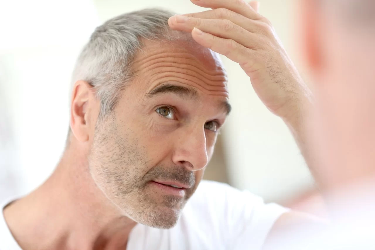 Alopecia Androgenética